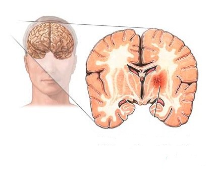 Симптомы рака головного мозга
