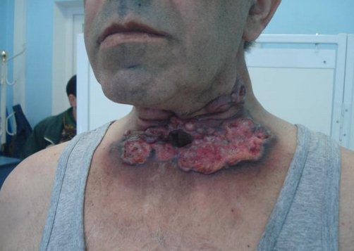 Человек болеющий раком гортани