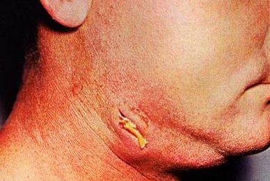 Человек с прогрессирующим актиномикозом