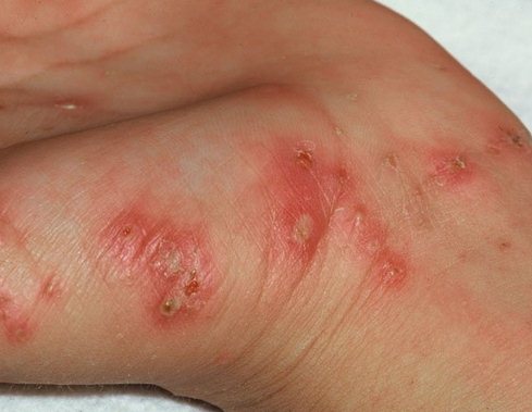 Симптомы чесотки у болеющего человека