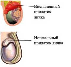 Эпидидимит