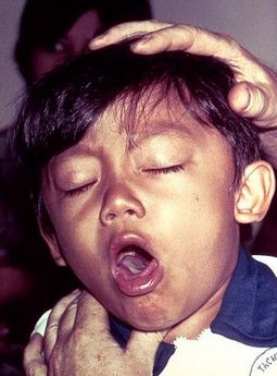 Ребенок больной коклюшем