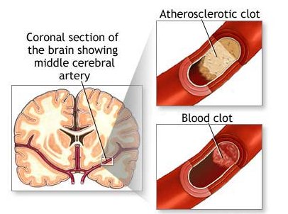 Симптомы паркисонизма