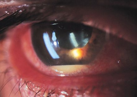 Острый иридоциклит