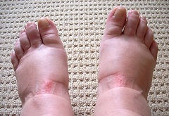 Отеки - один из признаков гестоза