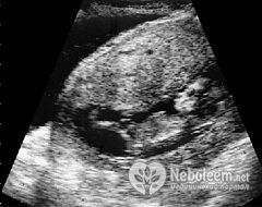 Длина плода на 12 неделе беременности - 6-7 см