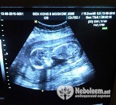 Вес плода на 18 неделе беременности - 200 грамм