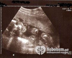 По УЗИ на 24 неделе беременности видно, что малыш отчетливо реагирует на свет