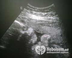 Вес малыша на 31 неделе беременности - 1500 грамм