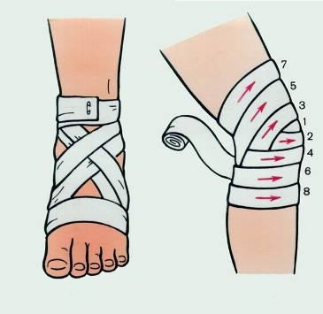 Фиксация травмированной конечности при растяжении связок