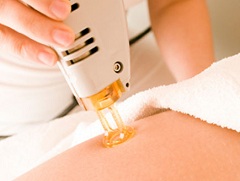 Процедура лазерной эпиляции ног