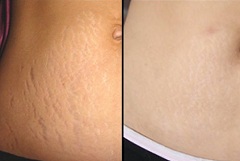 До и после удаления растяжек