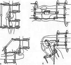 Аппарат Илизарова предназначается для фиксации несросшегося перелома Аппарат Илизарова предназначается для фиксации несросшегося перелома