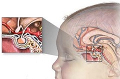 Опухоль головного мозга - одна из причин гипопитуитаризма