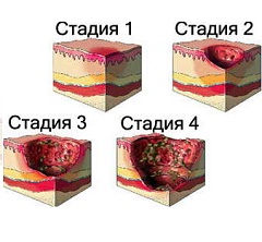 Выделяют 4 стадии пролежней