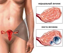 Ретенционные кисты яичников
