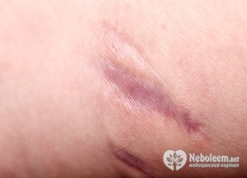 Технология удаления шрамов лазером