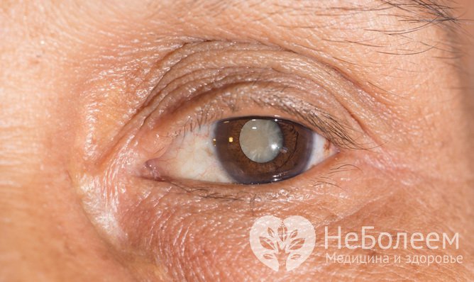 Катаракта - это пленка на глазу