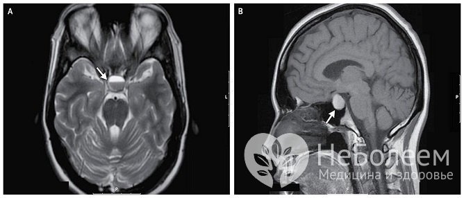 Аденома гипофиза диагностирована при проведении МРТ турецкого седла