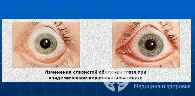 Аденовирусный конъюнктивит