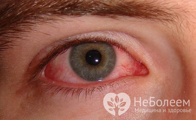 При аденовирусной инфекции часто развивается конъюнктивит