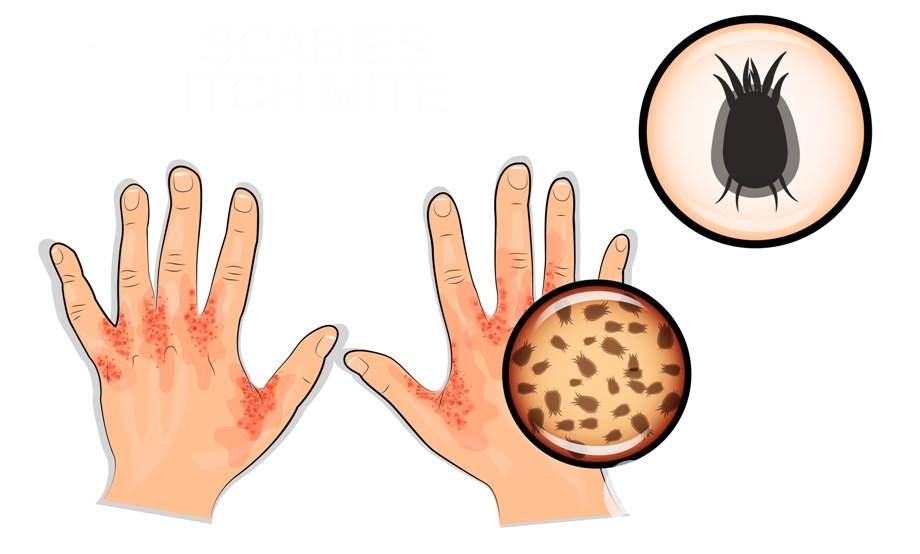 Симптомы акариазов