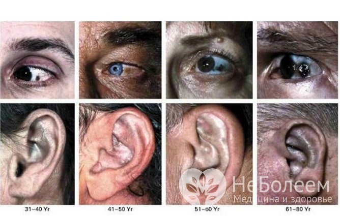 Внешние проявления алкаптонурии у лиц разного возраста