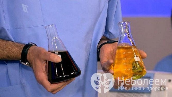 Диагностика алкаптонурии не представляет сложности из-за быстрого потемнения мочи на воздухе