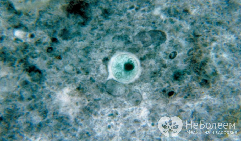 Entamoeba histolytica - возбудитель амебиаза