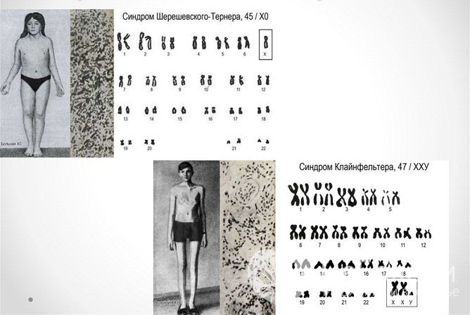 Анеуплоидия по половым хромосомам