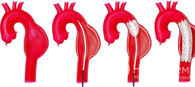 Эндопротезирование аневризмы аорты
