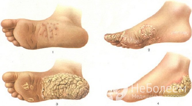 Невоидная ограниченная ангиокератома Мибелли