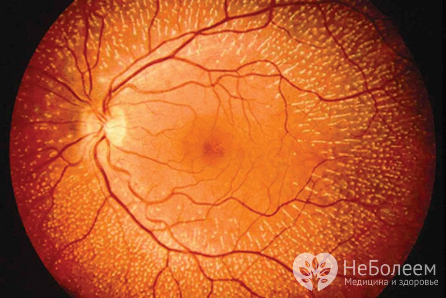 Симптомы ангиопатии