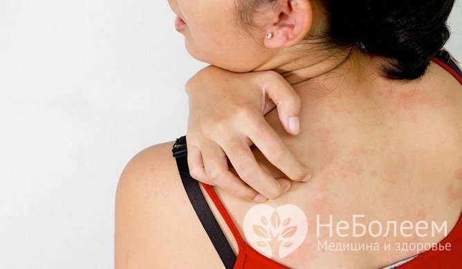 Жжение и зуд кожи – распространенные проявления анкилостомоза