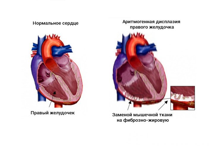 Признаки течения аритмогенной дисплазии правого желудочка 