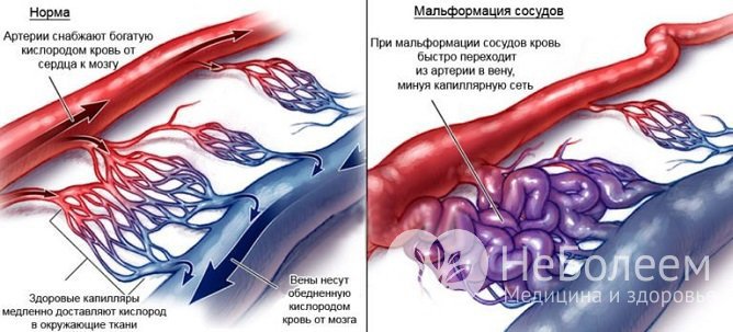 Артериовенозная мальформация способна локализоваться в любой части тела, но чаще всего – в сосудах шеи и головы