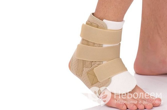 На поздних стадиях артроза наблюдается нестабильность голеностопного сустава, что может стать причиной надрывов и растяжений связок