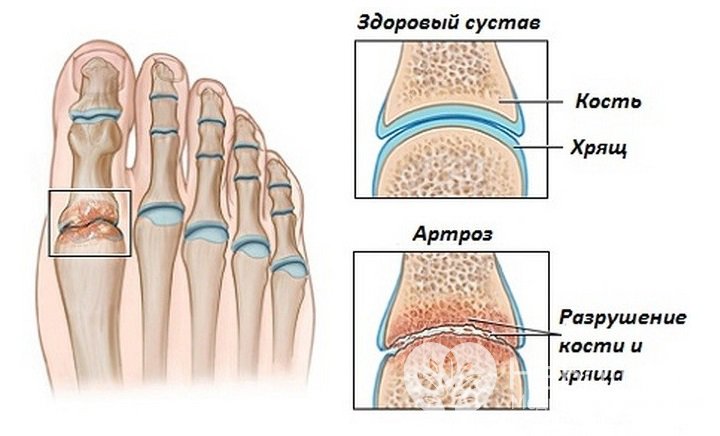 Признаки артроза стропы