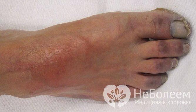 Проявление атеросклероза нижних конечностей поздней стадии