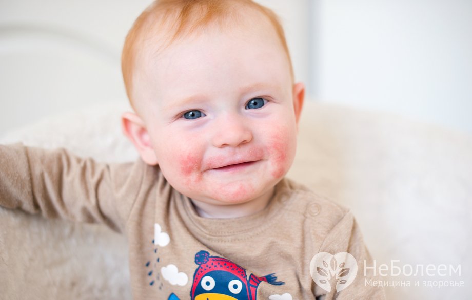 Симптомы атопического дерматита у детей