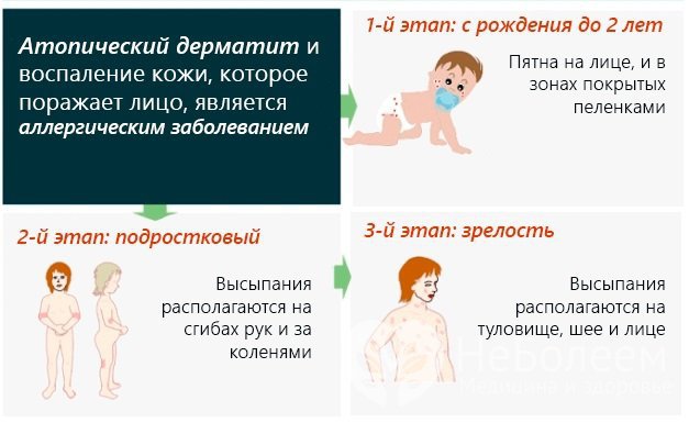 Этапы (стадии) атопического дерматита