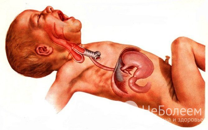 При атрезии пищевода слюна, слизь, пища попадает в дыхательные пути