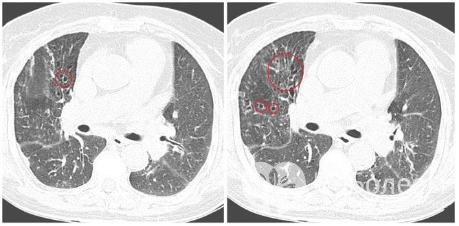 Визуализация бронхоэктазов на КТ