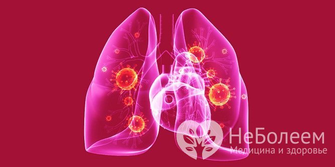 В большинстве случаев к развитию двухсторонней пневмонии приводит инфицирование грамположительными бактериями