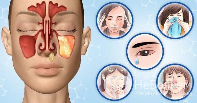 Гайморит у детей сопровождается головными болями, насморком, нарушением носового дыхания