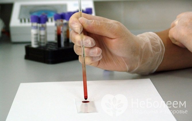 Для диагностики гирсутизма женщина сдает кровь на уровень гормонов