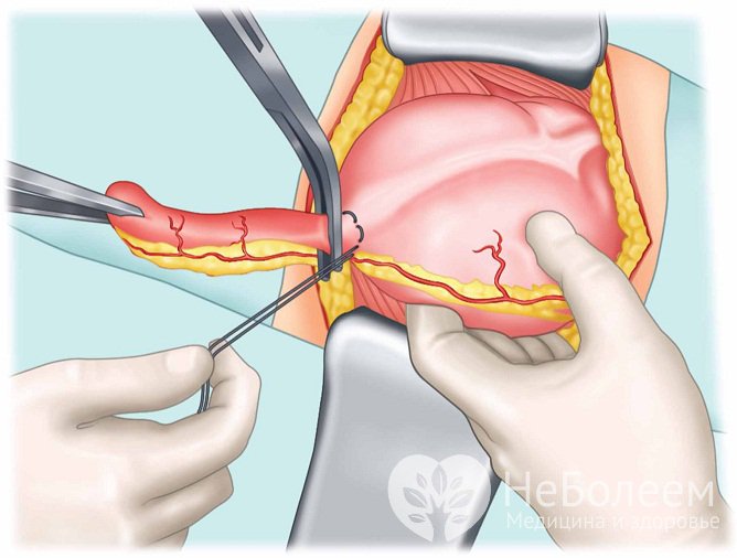 Операция по удалению аппендикса выполняется в том случае, если диагноз «хронический аппендицит» не вызывает сомнений