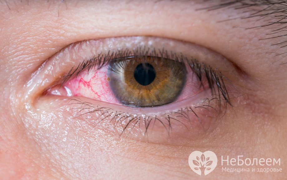 Симптомы кератоконъюнктивита