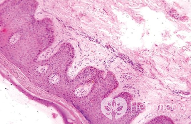 Отрубевидный лишай возникает вследствие поражения эпидермиса дрожжеподобными грибами