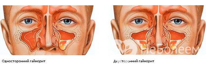 Острый гайморит может быть односторонним или двухсторонним